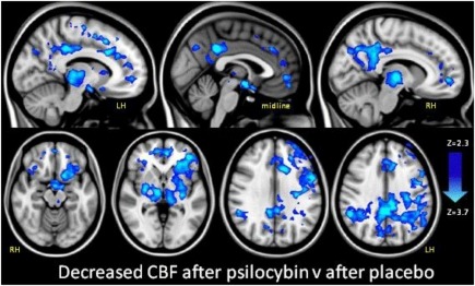 psilocybin brain scan1a
