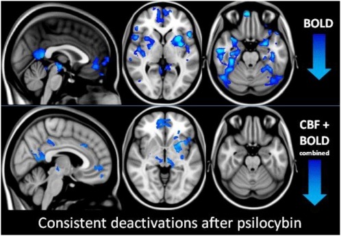 psilocybin brain scan2